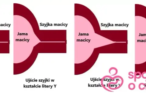 Skracanie szyjki macicy przed porodem: objawy, tempo, kiedy do lekarza?