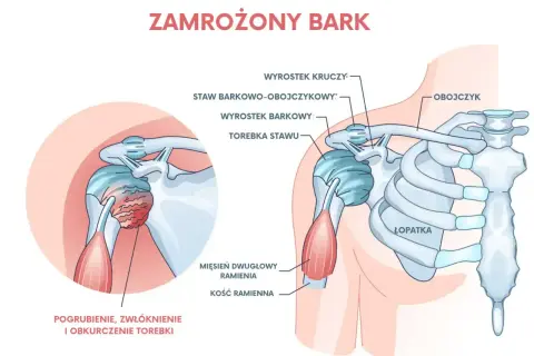 Ilustracja przedstawia zamrożony bark, pokazując pogrubienie i zwłóknienie torebki stawu. Ćwiczenia mogą pomóc w leczeniu bólu barku.