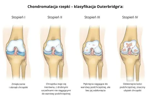Klasyfikacja Outerbridge'a pokazuje cztery stopnie chondromalacji rzepki: od zmiękczenia chrząstki (stopień I) do odsłonięcia kości (stopień IV).