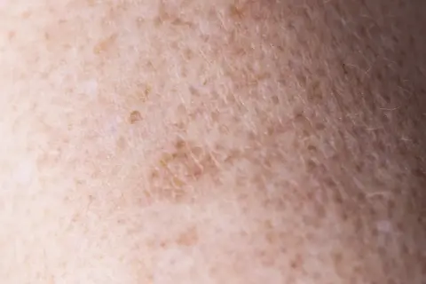 Zbliżenie na skórę z przebarwieniami, gdzie widać nierównomierne rozmieszczenie melaniny. To właśnie melanina co to jest, decyduje o kolorze skóry.