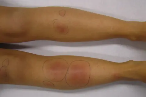 Gambe con segni di pizzichi, arrossamenti e gonfiori evidenziati da cerchi a matita.