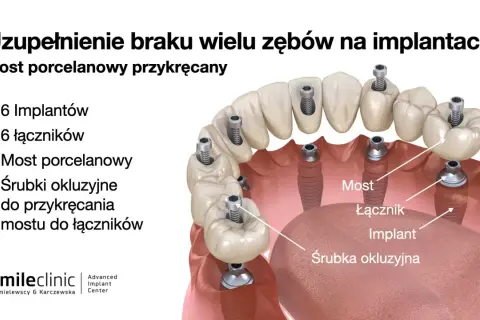 Ilustracja pokazuje, jak uzupełnić brak jednego zęba za pomocą mostu porcelanowego przykręcanego na 6 implantach. Widoczne są implanty, łączniki i śrubki.