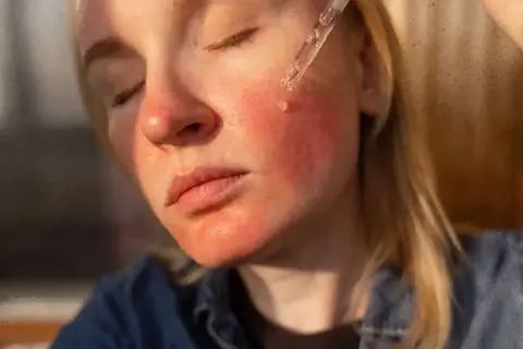 Cera zaczerwieniona, z widocznym wysypem po niacynamidzie. Kropla serum z pipety spada na policzek.