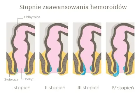 Ilustracja przedstawia cztery etapy rozwoju hemoroidów zewnętrznych, od I do IV stopnia, pokazując ich stopniowe powiększanie się.