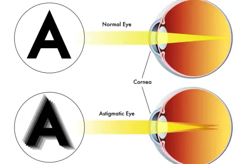 Astygmatyzm: Okulista czy optometrysta? Rozwiej wątpliwości i zobacz ostro!