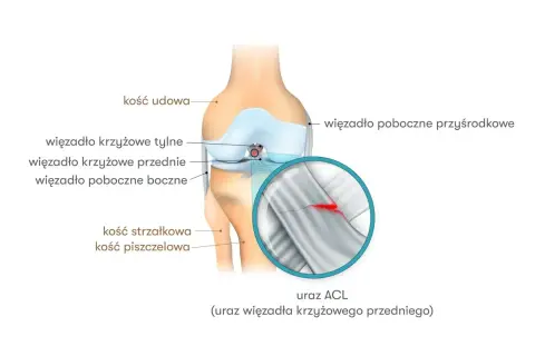 Anatomia kolana z zaznaczonym zerwanym więzadłem krzyżowym przednim (ACL). Powiększenie pokazuje pęknięcie w strukturze więzadła.