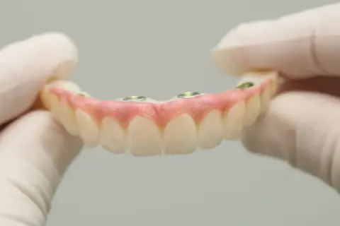 Górna proteza bez podniebienia, mocowana na implantach, prezentowana przez dłonie w rękawiczkach.