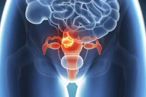 Illustration des weiblichen Beckens mit Fokus auf die Gebärmutter, die einen Tumor zeigt. Dies illustriert die Leitlinie Endometriumkarzinom.
