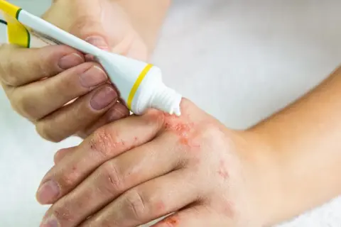 Osoba aplikuje dermovate maść na suchą, zaczerwienioną skórę dłoni.