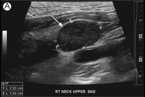 Ultraschallbild des Halses zeigt einen unauffälligen Lymphknoten mit Markierungen zur Größenmessung.