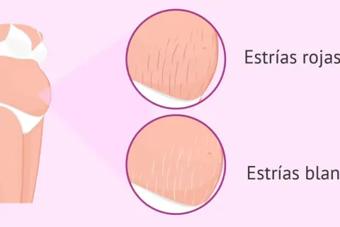 Ilustración de abdomen de embarazada con primeros planos de estrías rojas y blancas, mostrando las marcas comunes del embarazo.
