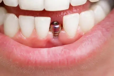 Implant zęba przed i po: metalowy filar wystaje z dziąsła, czekając na koronę.
