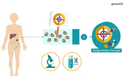 Illustration zeigt die Behandlung eines niedrig malignen Lymphoms mit zielgerichteter Therapie. Eine Spritze zielt auf Krebszellen.
