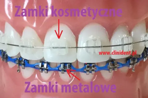 Aparat na zęby: zobacz, jak wygląda! Od metalu po niewidoczne