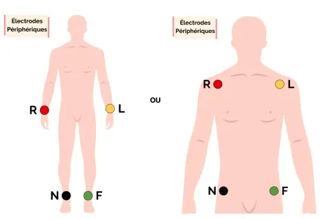 Schéma montrant le placement des électrodes périphériques pour un ECG.