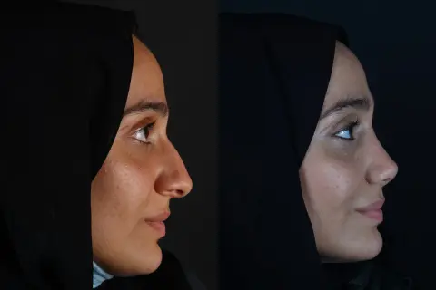 Przed i po: subtelna rhinoplastyka co to jest? Zmiana profilu nosa, poprawa harmonii twarzy.