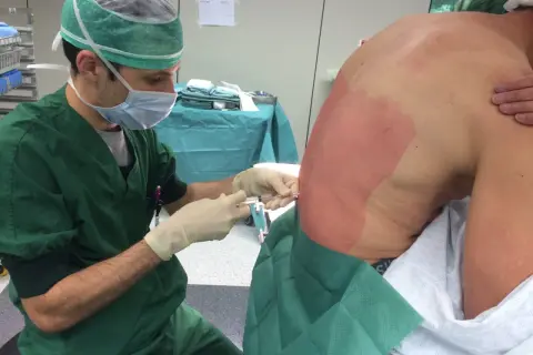 Un médecin administre une anesthésie péridurale à un patient. La zone du dos du patient est désinfectée et préparée pour l'injection.