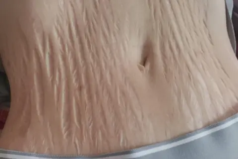Nahaufnahme des Bauches mit vielen hellen Dehnungsstreifen, die wie ein natürliches Tattoo aussehen.
