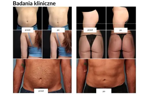 Badania kliniczne pokazują spektakularne trening ems efekty przed i po: widoczna redukcja tkanki tłuszczowej na brzuchu i pośladkach.