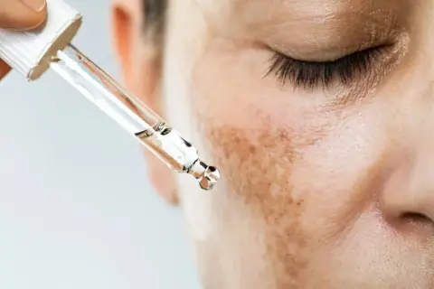 Gotas de suero aplicándose sobre manchas melasma en la mejilla de una persona.