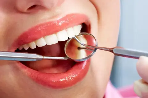 Uśmiech z błyszczącymi zębami, badany lusterkiem dentystycznym. Czy bonding jest odwracalny? To pytanie nurtuje wielu pacjentów.