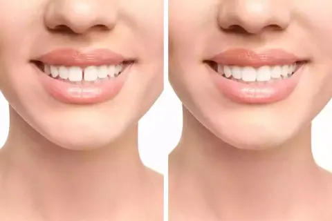 Prima e dopo: il diastema, ovvero lo spazio tra i denti, viene corretto per un sorriso perfetto.