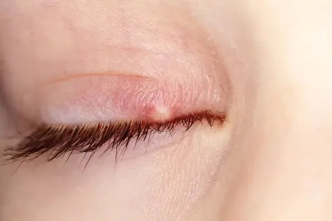 Gros plan d'un paupière avec un bouton blanc oeil, rouge et enflammé, près des cils.
