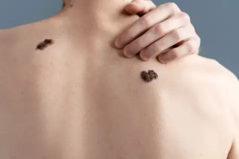 Rücken mit mehreren schwarzen Muttermalen. Eine Hand ruht auf der Schulter.