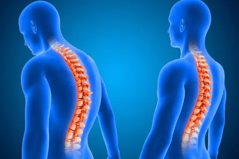 Due figure umane blu mostrano la colonna vertebrale in evidenza arancione. Una ha la schiena insaccata, l'altra una postura eretta.