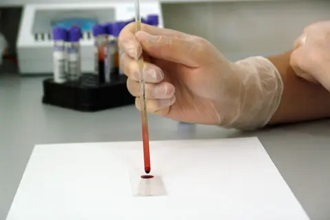 Ręka w rękawiczce pobiera próbkę krwi do badania. Cena hemoglobiny glikowanej jest kluczowa dla monitorowania cukrzycy.