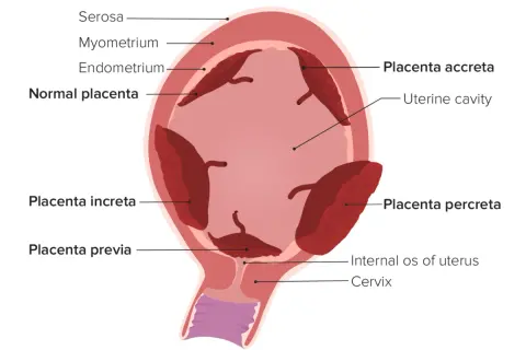 Schematische Darstellung des Uterus mit verschiedenen Plazentapositionen. Was ist die Plazenta? Sie ist ein Organ, das sich während der Schwangerschaft entwickelt.