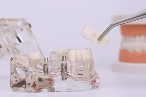 Model szczęki z implantami, na którym pęseta trzyma gotową koronę na implancie.