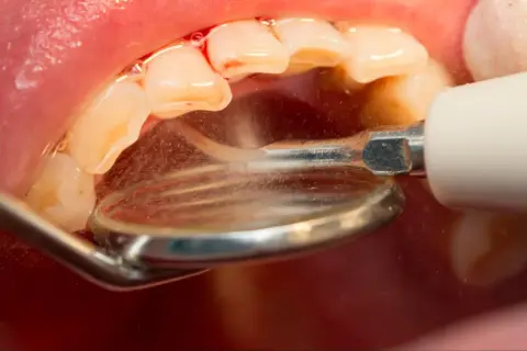 Dentysta usuwa kamień z zębów ultradźwiękami. Skuteczny sposób, jak pozbyć się kamienia na zębach, by mieć piękny uśmiech.