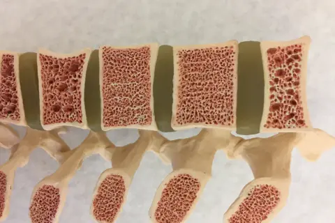 Model kręgosłupa z widocznym przekrojem kości, ukazującym gąbczastą strukturę. Widać liczne pory wewnątrz **bonevum**, co przypomina plaster miodu.