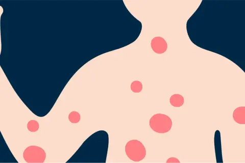 Illustration d'un torse et d'un bras avec des plaques rouges, évoquant l'eczéma sur le dos et le corps.