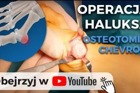 Operacja haluksów: Wybierz klinikę i metodę. Poradnik.