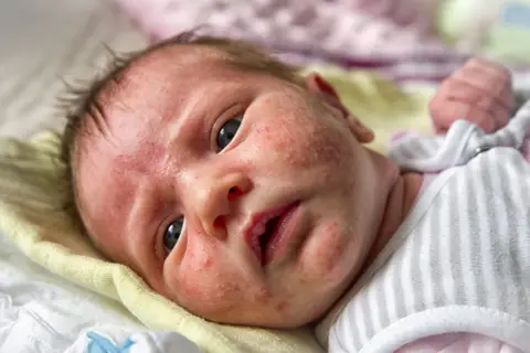 Twarz niemowlaka z zaczerwienieniami i licznymi krostkami, które mogą być objawem ropnego pryszcza u niemowlaka.