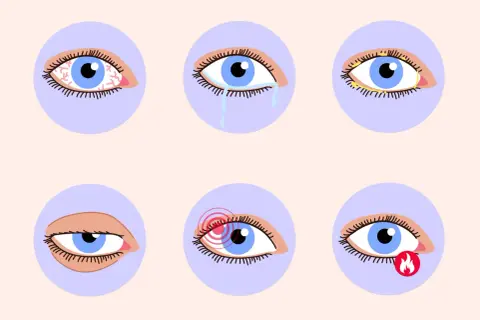 Sechs Augen zeigen verschiedene trockene Augen Symptome: Rötung, Tränen, Verkrustung, Schmerz, Brennen und ein müdes Auge.