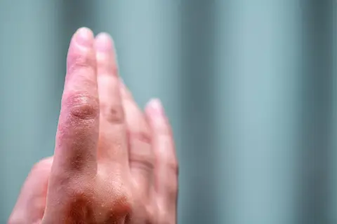Skóra na opuszkach palców rąk jest zaczerwieniona i lekko łuszcząca się, co może wskazywać na swędzenie opuszków palców u rąk.