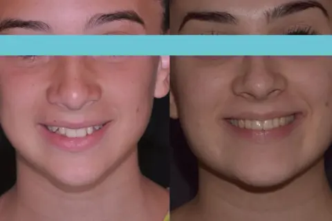 Prima e dopo: un sorriso più armonioso con una mascella pronunciata che valorizza il volto.