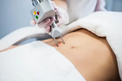 Liposukcja kawitacyjna: Jak często dla trwałych efektów?