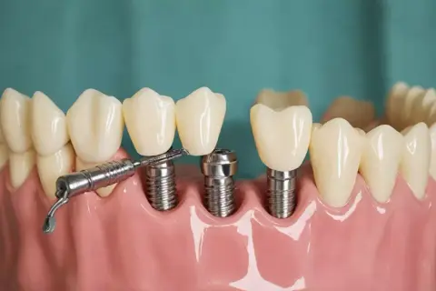 Model szczęki z implantami zębów i narzędziem. Sprawdź nasz cennik implantów zębów.