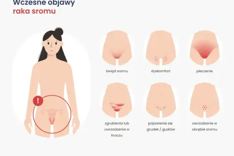 Ilustracja pokazuje wczesne objawy raka sromu: świąd, dyskomfort, pieczenie, zgrubienia, grudki i owrzodzenia.