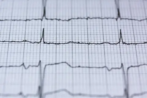 EKG pokazuje rytm serca. Czy nerwica serca wyjdzie na EKG? Zapis pokazuje fale, które mogą być interpretowane przez lekarza.