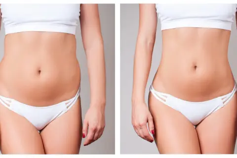 Avant/après d'une liposuccion ventre. Une silhouette affinée et une taille plus marquée après l'intervention.