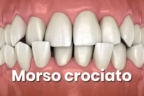 Denti bianchi e sani con un evidente morso incrociato, dove i denti superiori coprono parzialmente quelli inferiori.