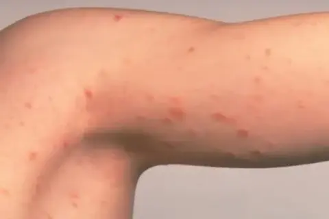 Brazo con erupción de pequeños puntos rojos, posiblemente hongos, manchas rosadas en la piel.