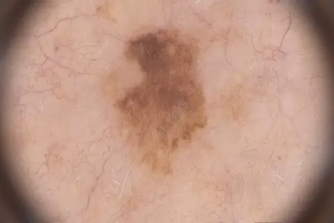 Dermatoskopische Aufnahme eines unregelmäßigen, braunen Muttermals mit feinen Gefäßen. Ein frühes Melanom zeigt sich oft so.