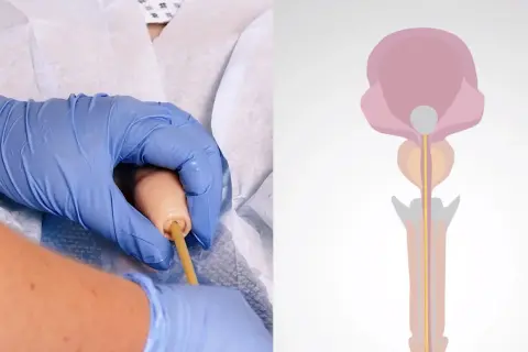 Hände mit blauen Handschuhen führen einen Katheter ein. Daneben eine schematische Darstellung des männlichen Urogenitaltrakts, die das Katheter legen illustriert.