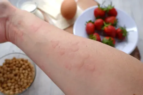 Ręka z wysypką alergiczną, w tle truskawki, jajko i fasola.